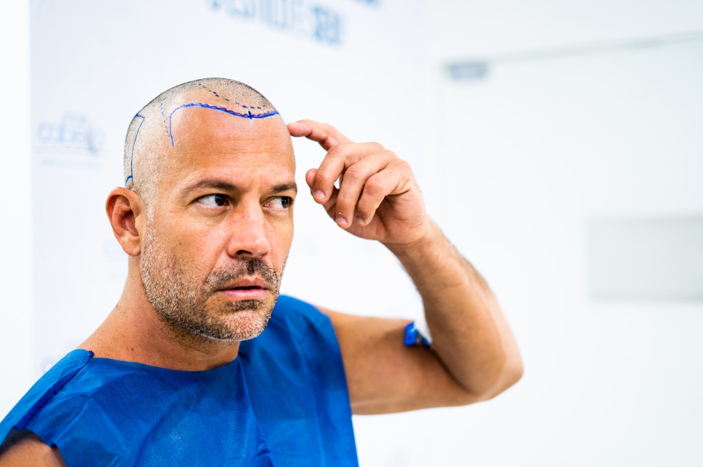 Paciente em avaliação para transplante capilar