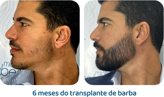 Barba resultado 1