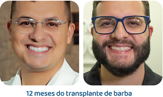 Barba resultado 2