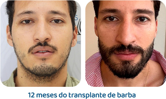 Barba resultado 3