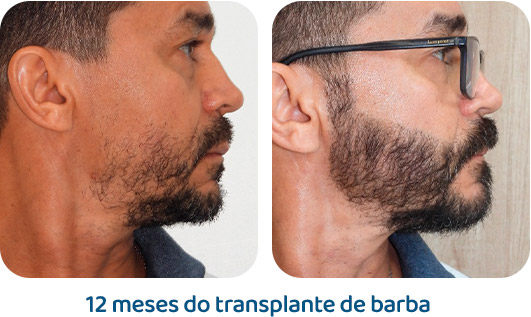 Barba resultado 4