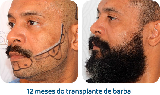 Barba resultado 5