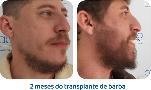 Barba resultado 6