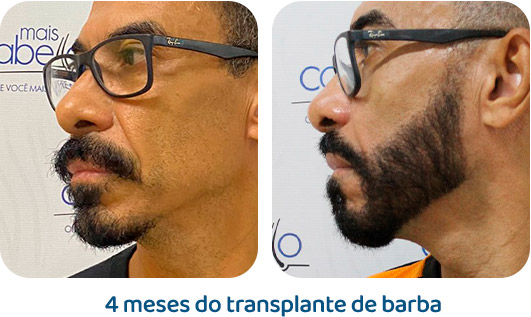 Barba resultado 7