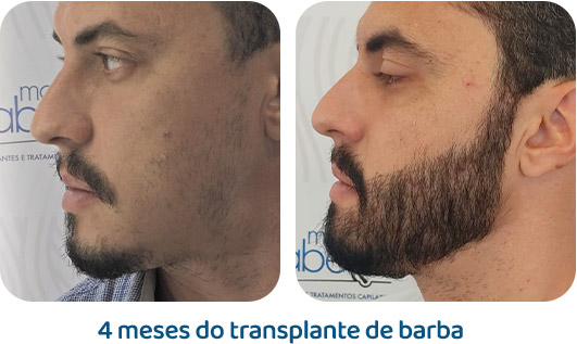 Barba resultado 8