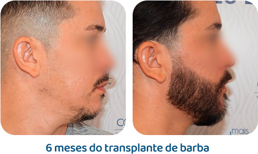 Barba resultado 9
