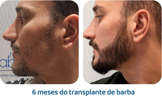 Barba resultado 10