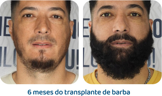 Barba resultado 11