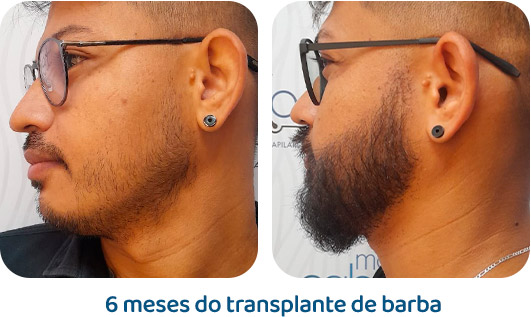 Barba resultado 12
