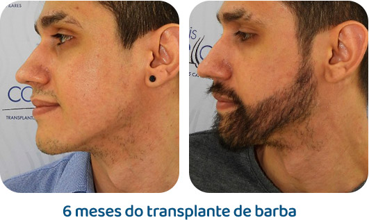 Barba resultado 13
