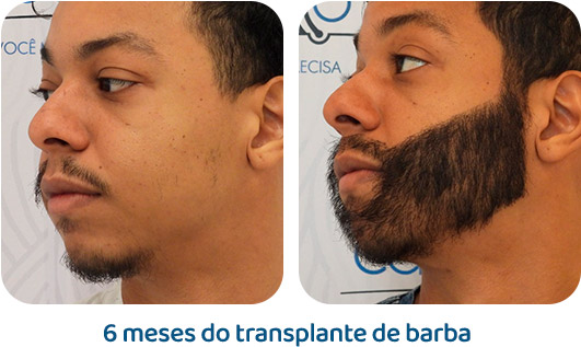 Barba resultado 14