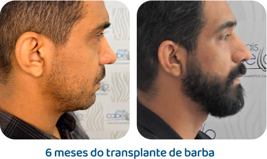 Barba resultado 15