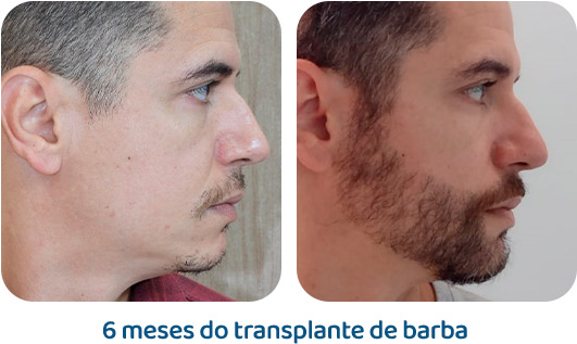 Barba resultado 16