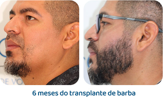 Barba resultado 17