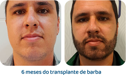Barba resultado 18
