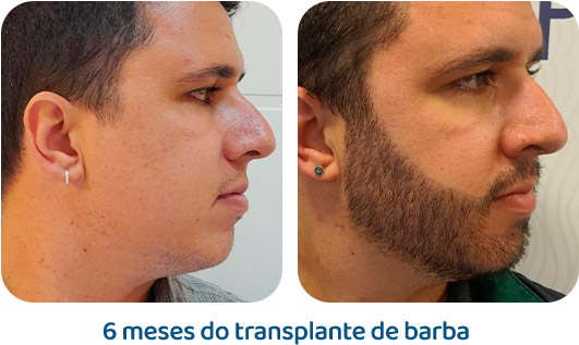 Barba resultado 19