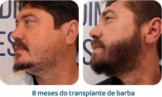 Barba resultado 20