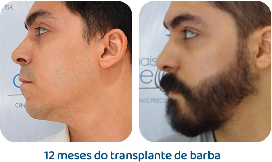 Barba resultado 21