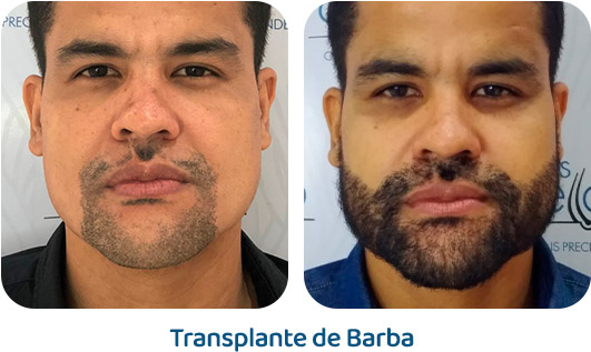 Barba resultado 22
