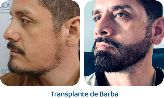 Barba resultado 23
