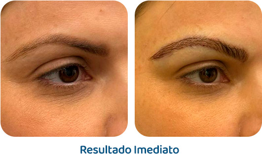 Sobrancelhas Everbrow resultado 2