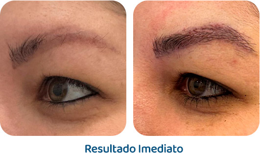 Sobrancelhas Everbrow resultado 3