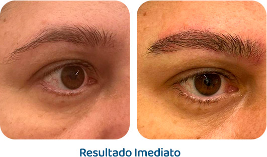 Sobrancelhas Everbrow resultado 4