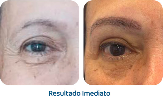 Sobrancelhas Everbrow resultado 7