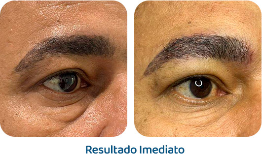 Sobrancelhas Everbrow resultado 9
