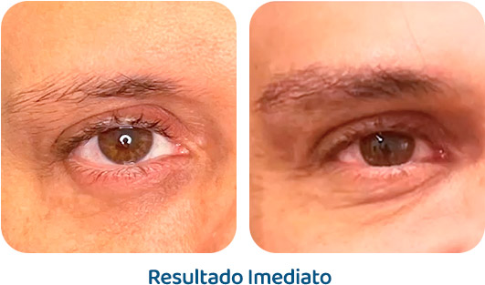 Sobrancelhas Everbrow resultado 11