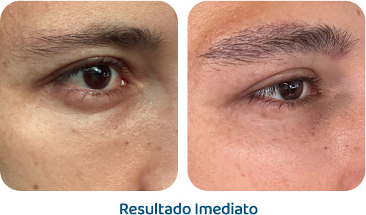 Sobrancelhas Everbrow resultado 12